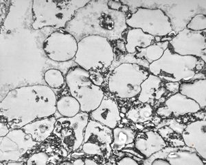 M,50y. | Pneumocystis carinii